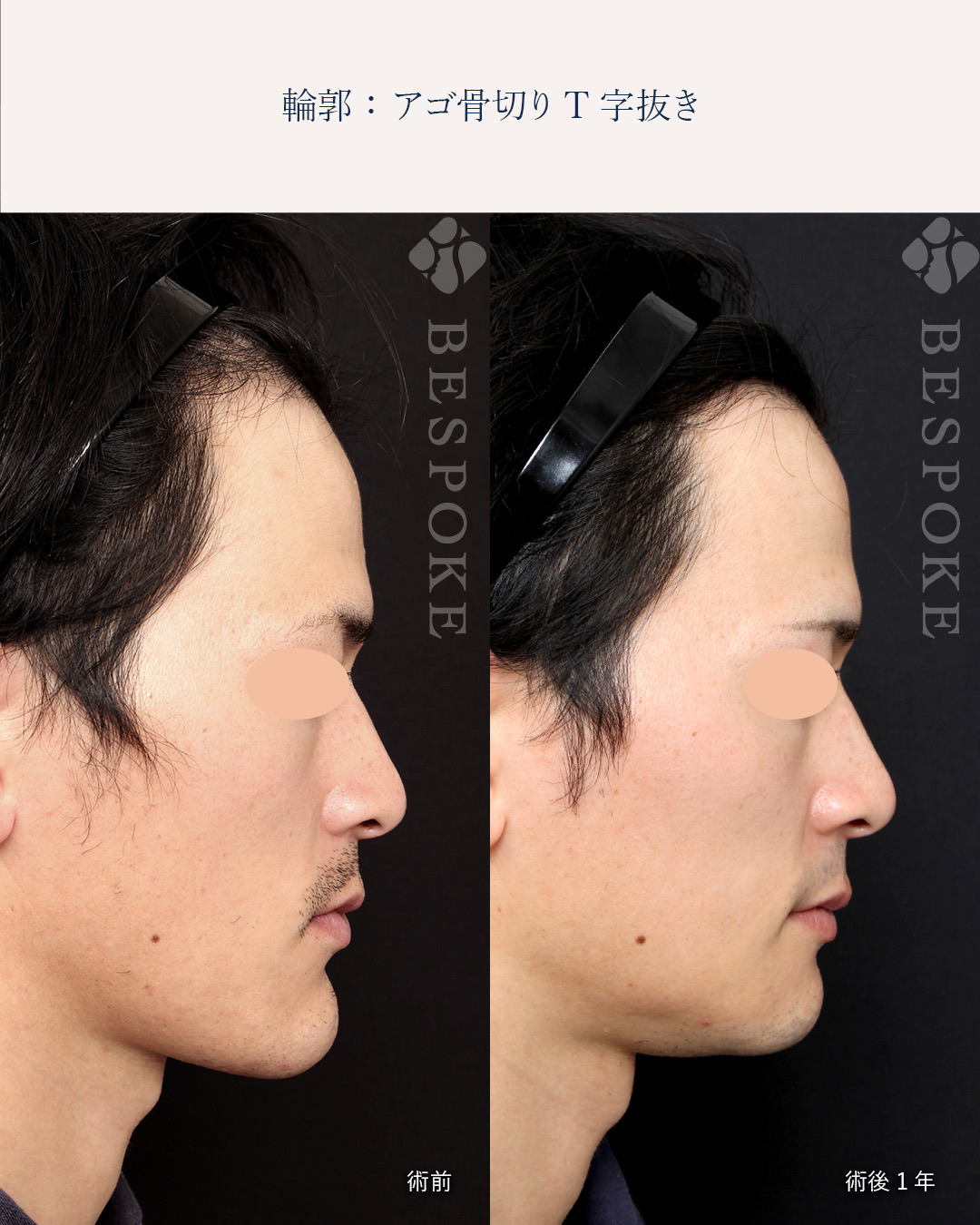 メンズ整形_顎骨切T字抜き3
