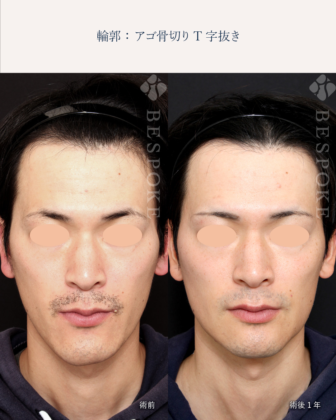 【顎骨切り】男らしさを残した輪郭形成