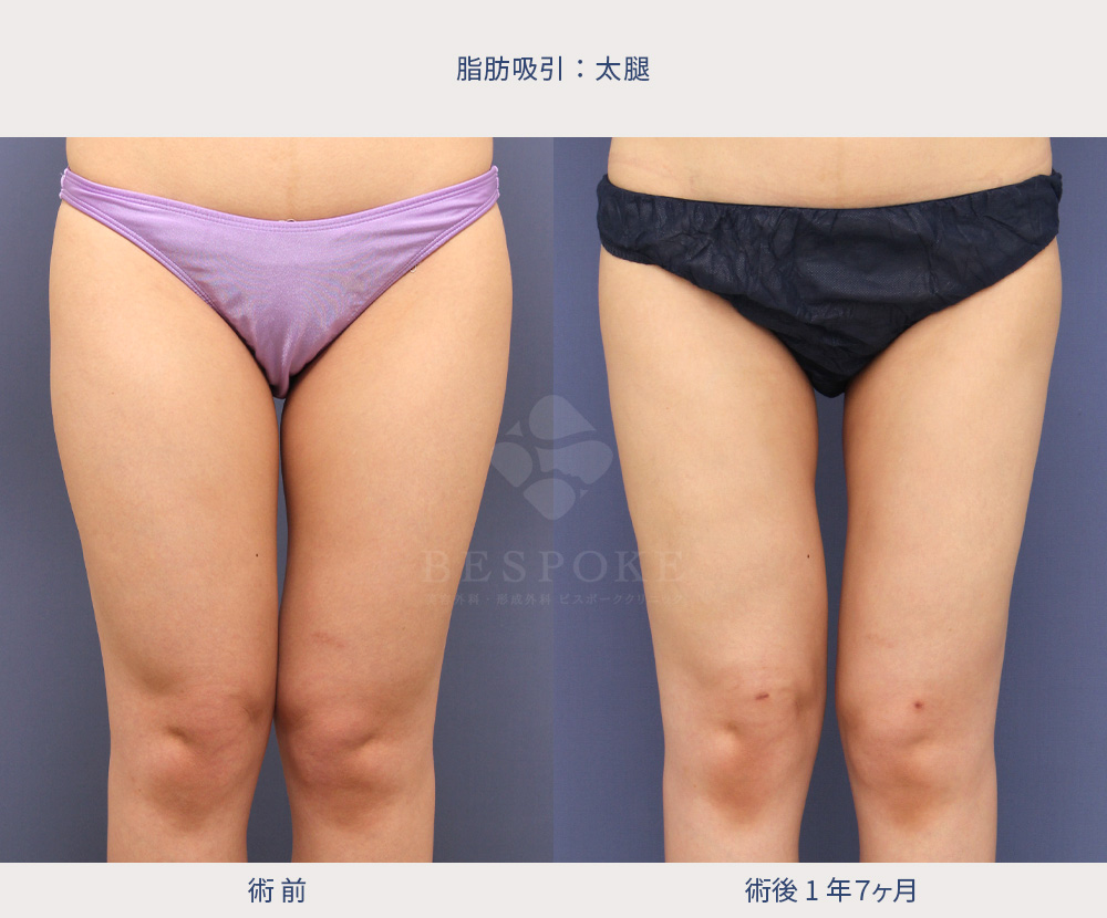 【脂肪吸引】デニムがつっかえてしまう太腿もスッキリ