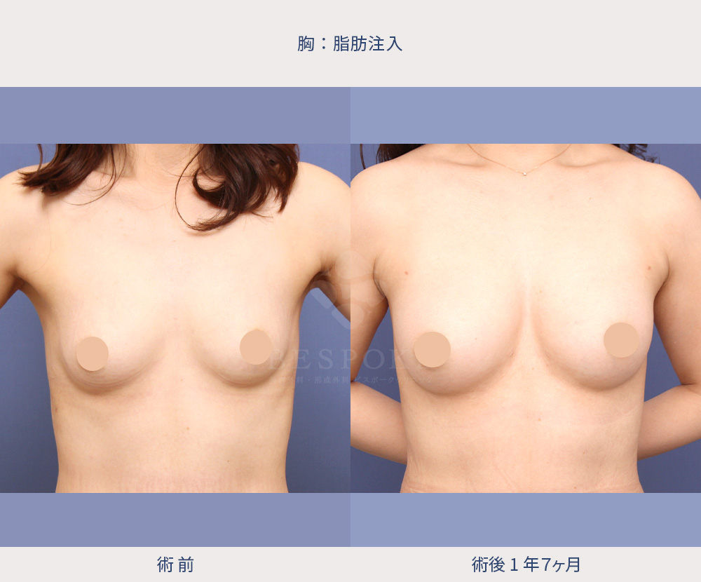 【脂肪豊胸】形を整える豊胸。デコルテ・谷間を自然に改善