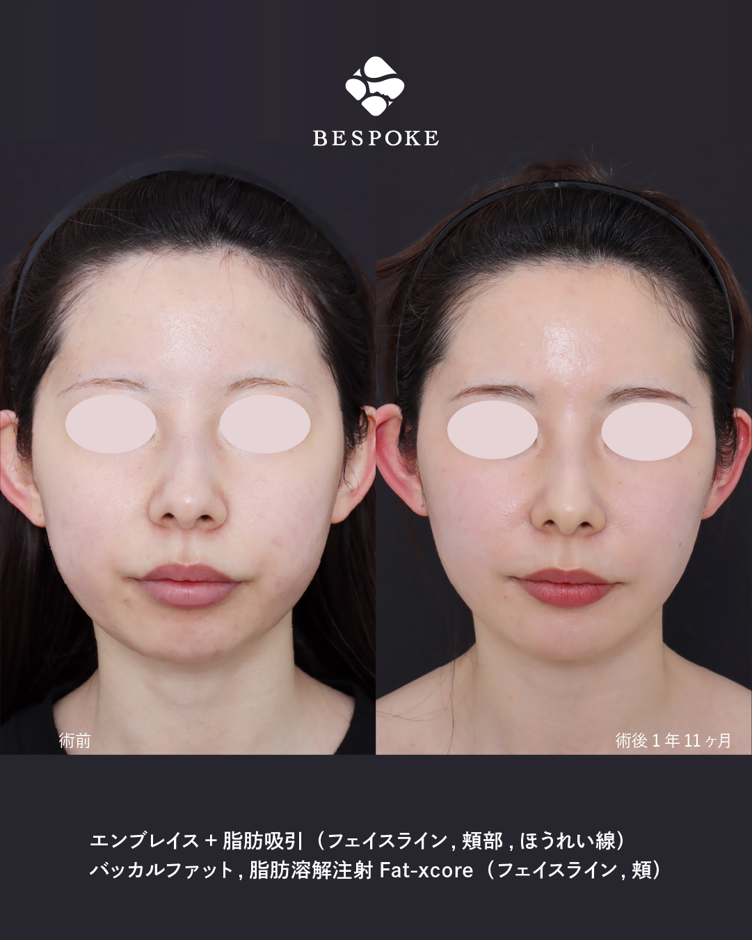 小顔・たるみ治療】口横のもたつきやたるみをエンブレイスRFで改善 