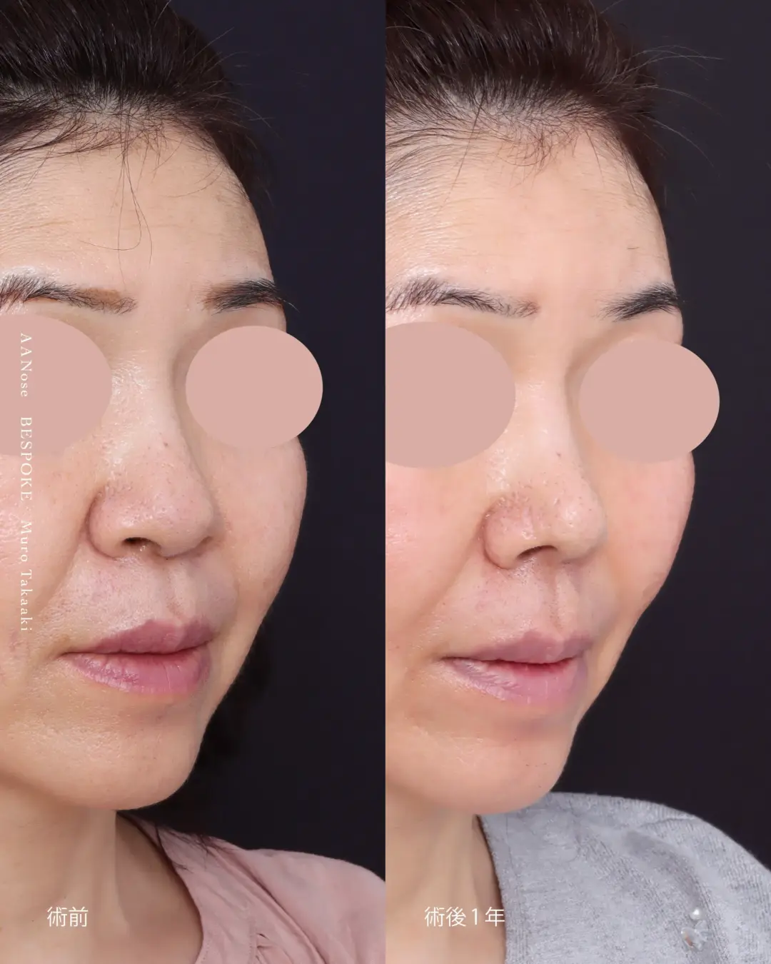 AANose6 (1) 鼻中隔延長術、鼻尖縮小術の症例