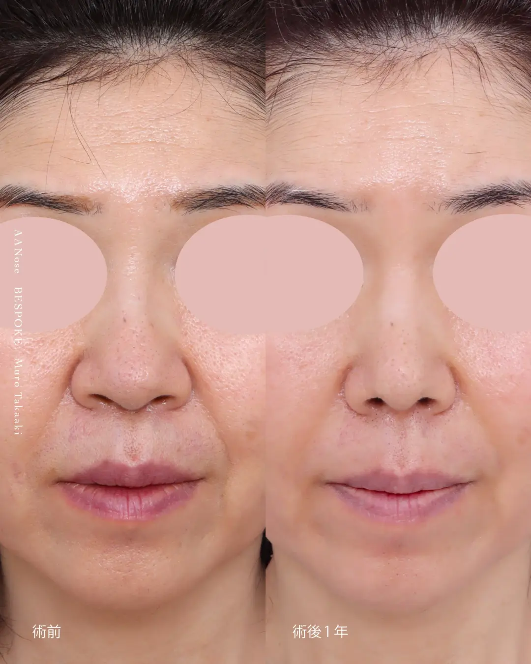 【鼻整形】加齢で重たい印象の鼻を小さくスッキリと改善