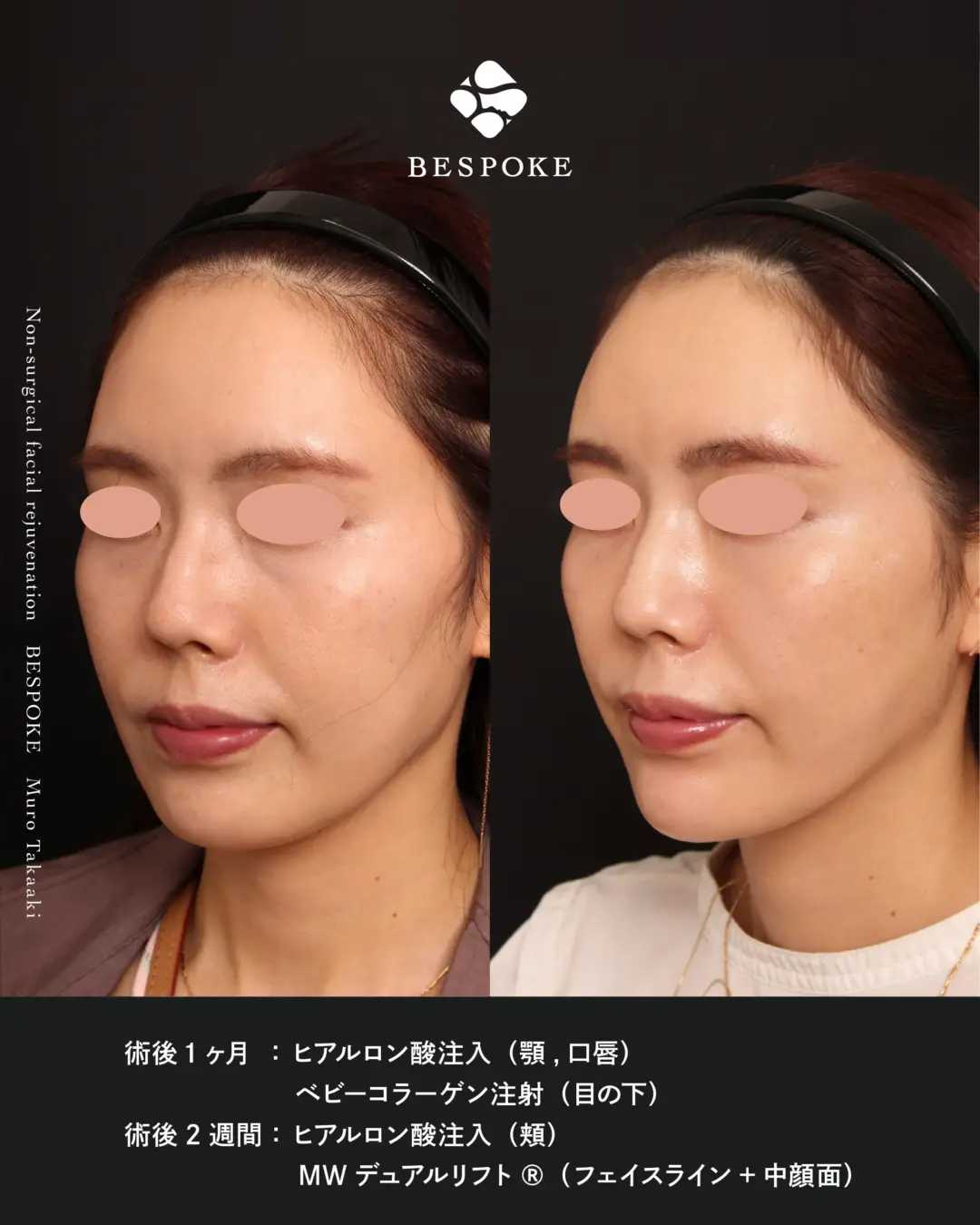 【ベビーコラーゲン】切らずに注入治療で目の下のクマを改善