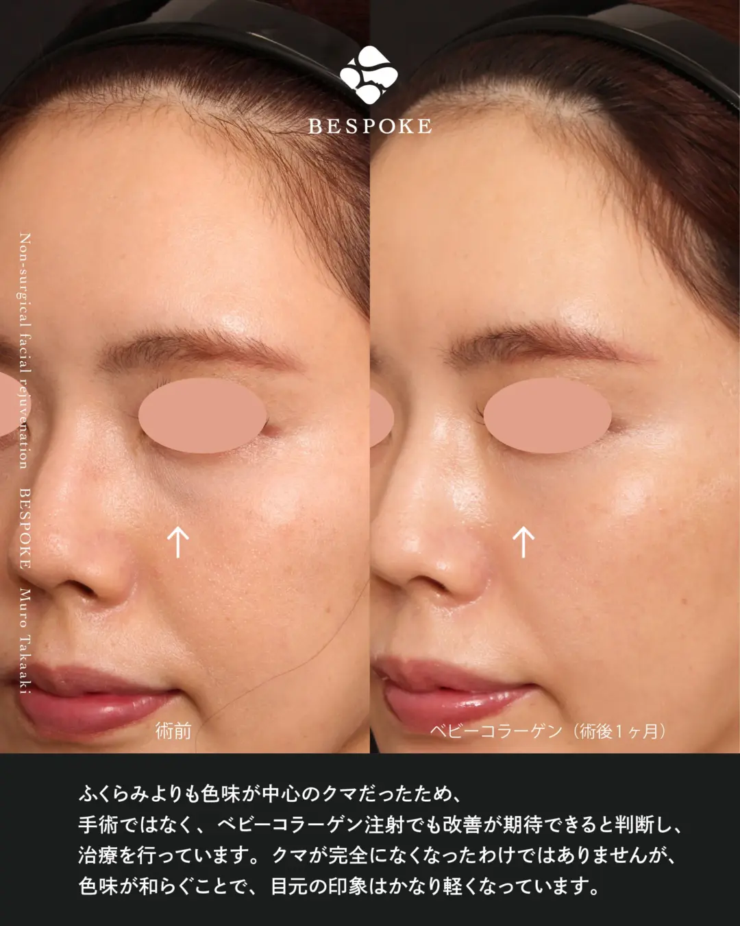 ヒアルロン酸、ベビーコラーゲン、MWデュアルリフトの症例