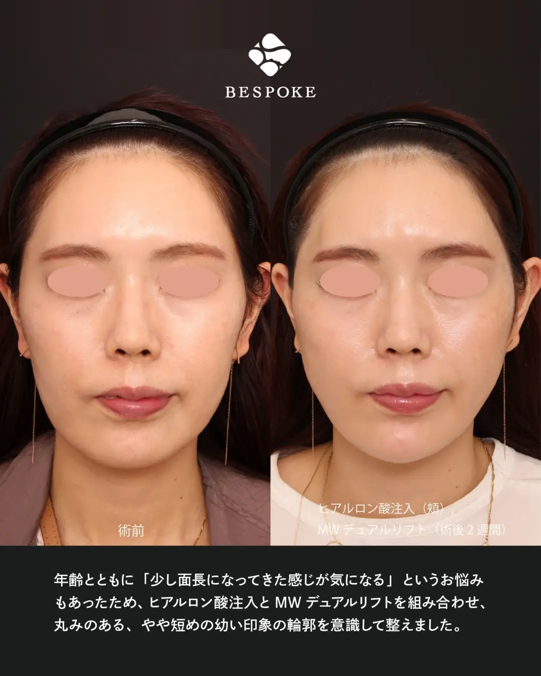 ヒアルロン酸、ベビーコラーゲン、MWデュアルリフトの症例