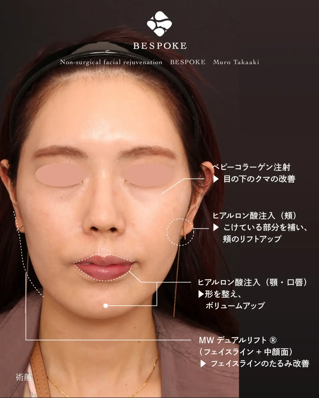 ヒアルロン酸、ベビーコラーゲン、MWデュアルリフトの症例
