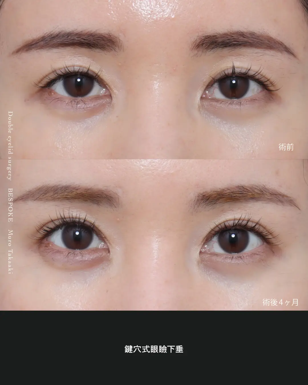 【鍵穴式眼瞼下垂】わずか7mmの傷あとでパッチリとした目元へ改善