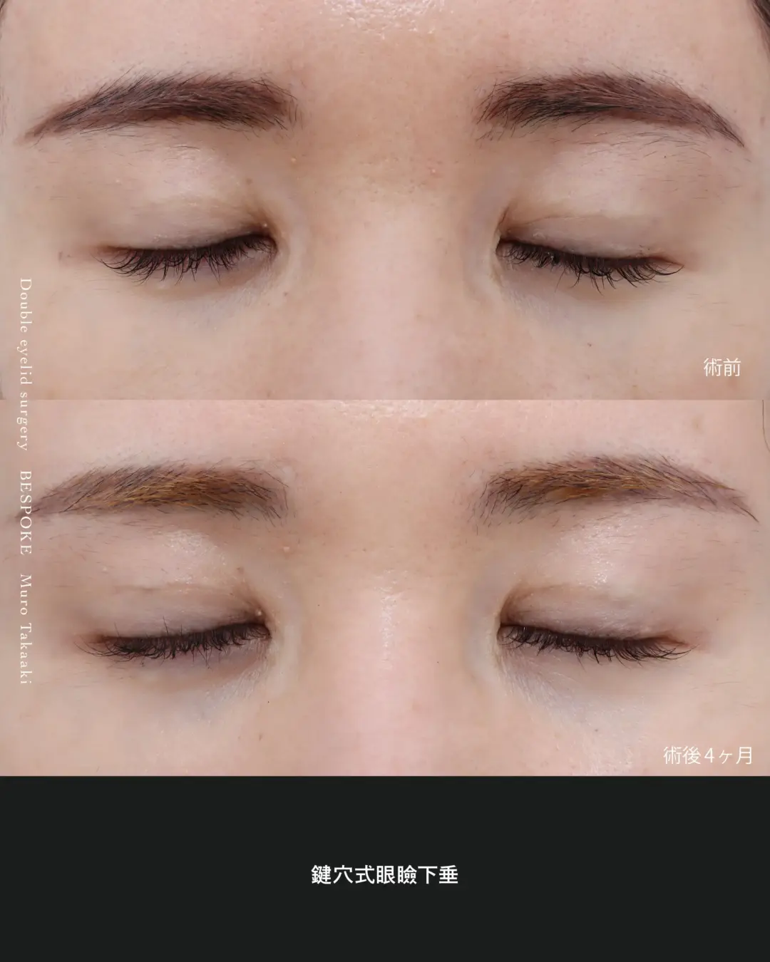 鍵穴式眼瞼下垂の症例