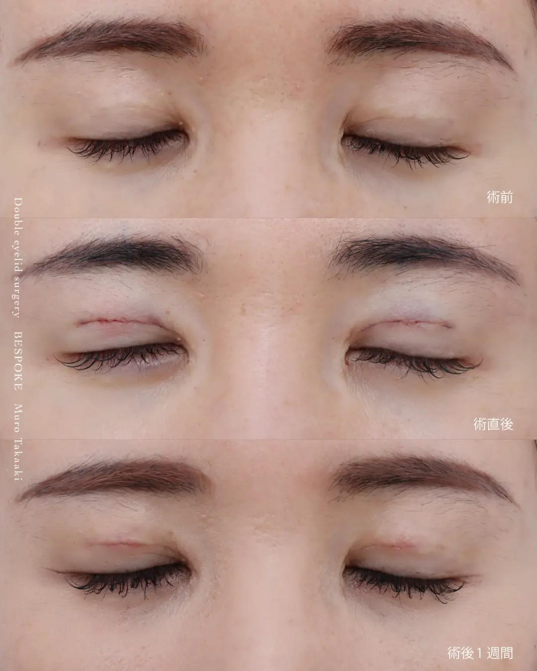 鍵穴式眼瞼下垂の症例