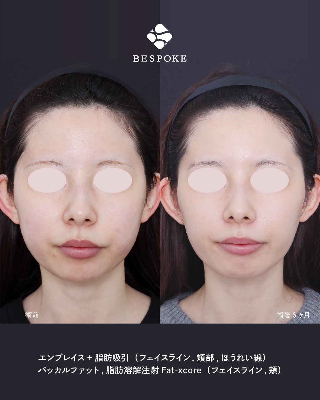 エンブレイス_2poy-01 エンブレイスの症例