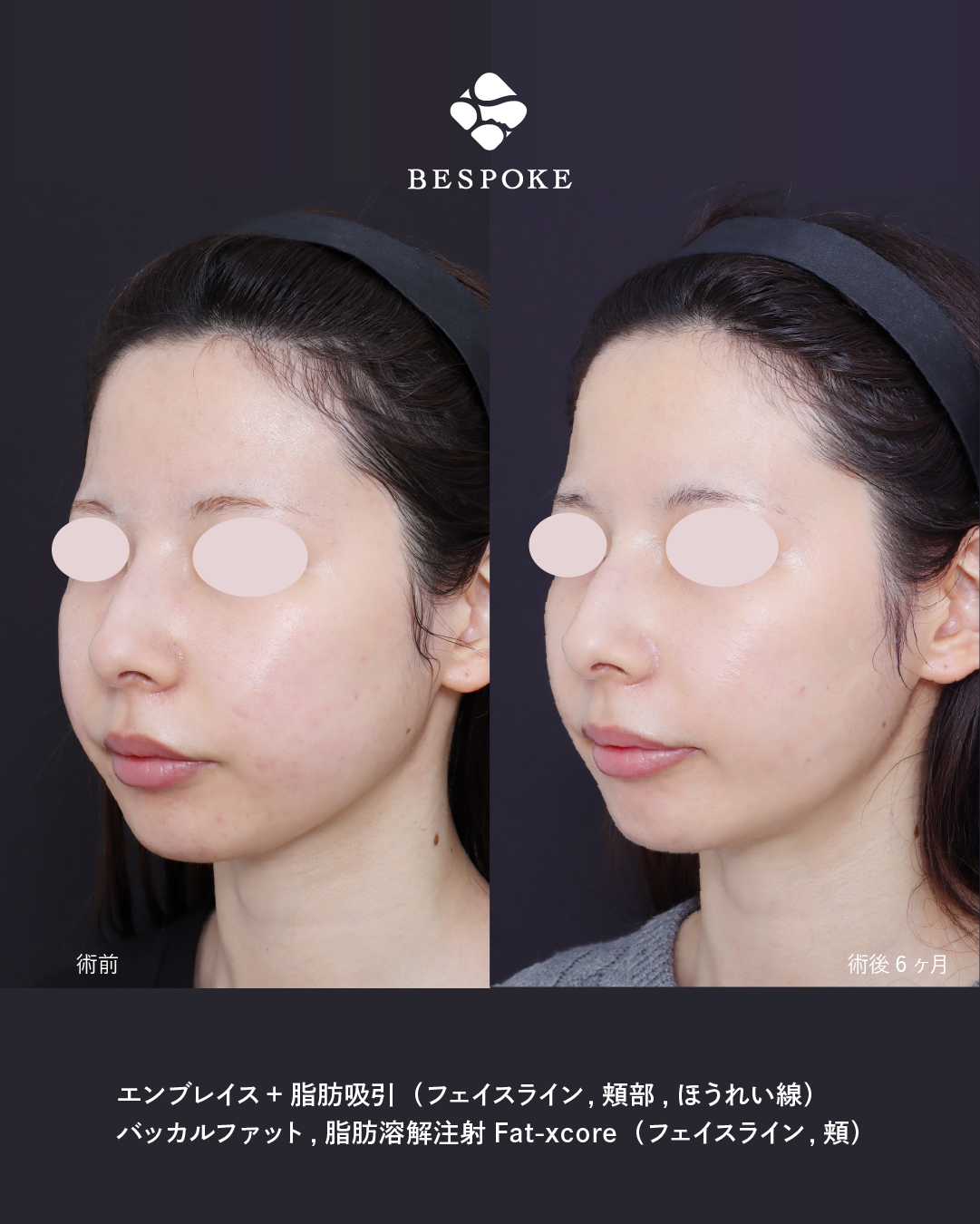 エンブレイス_2poy-02 エンブレイスの症例