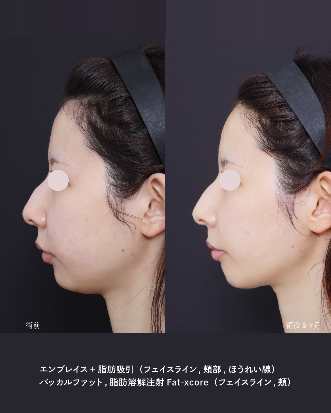 【小顔・たるみ治療】口横のもたつきやたるみをエンブレイスRFで改善