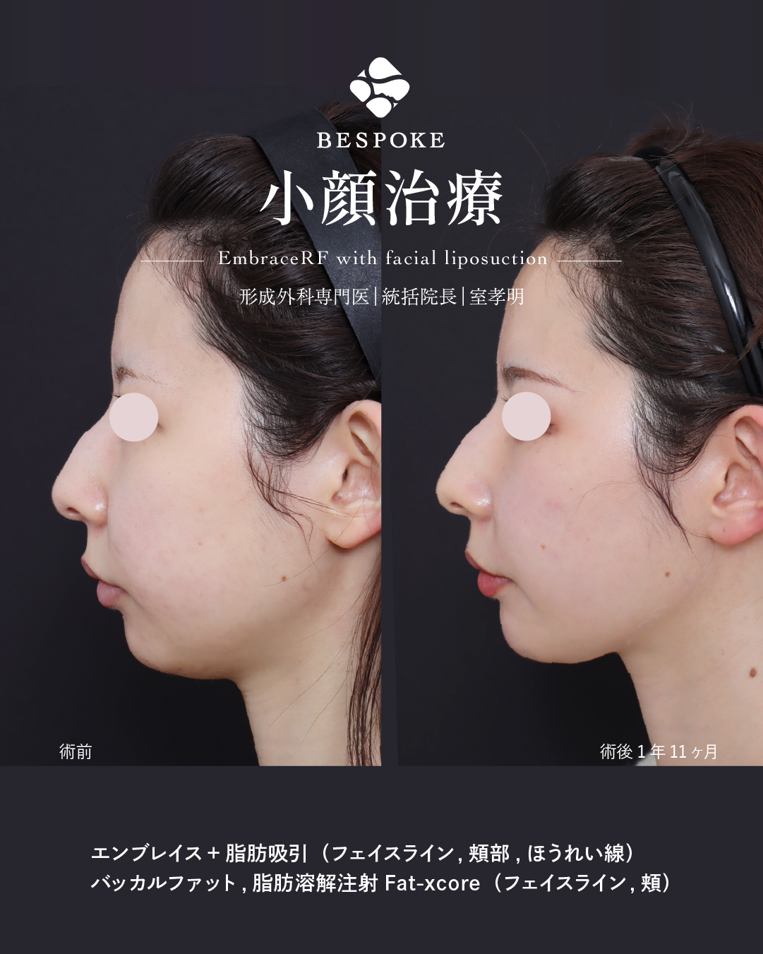 エンブレイス_2poy-04 エンブレイスの症例