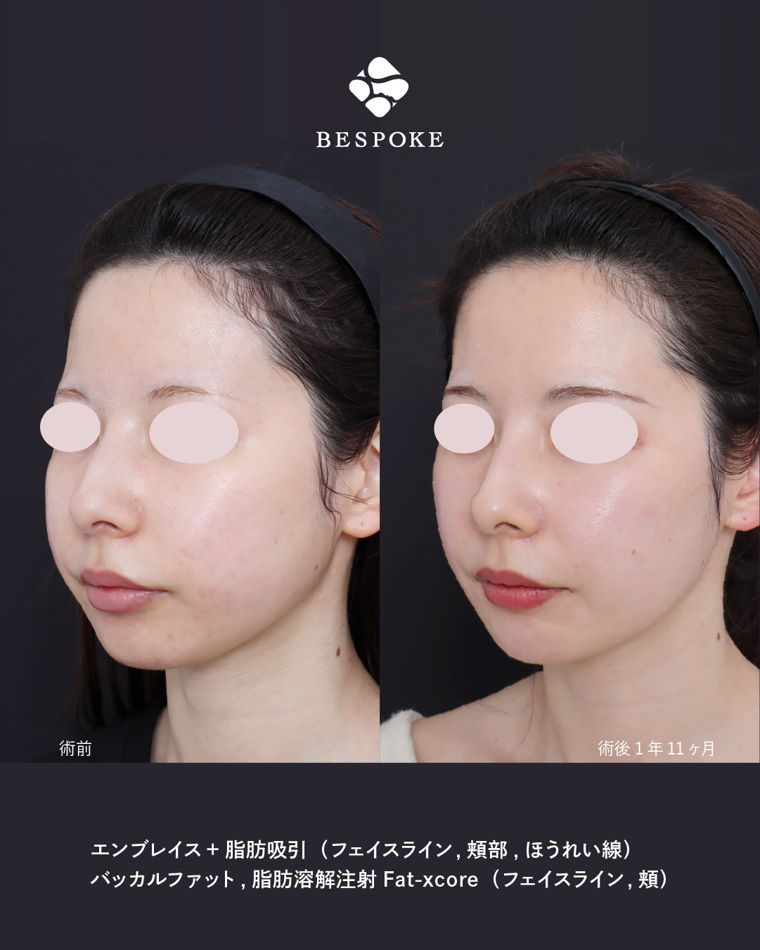 エンブレイス_2poy-05 エンブレイスの症例