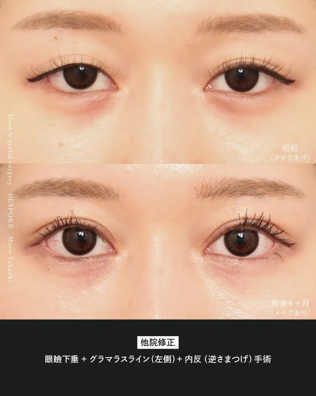 眼瞼下垂_260221 (1) 眼瞼下垂、グラマラスラインの症例