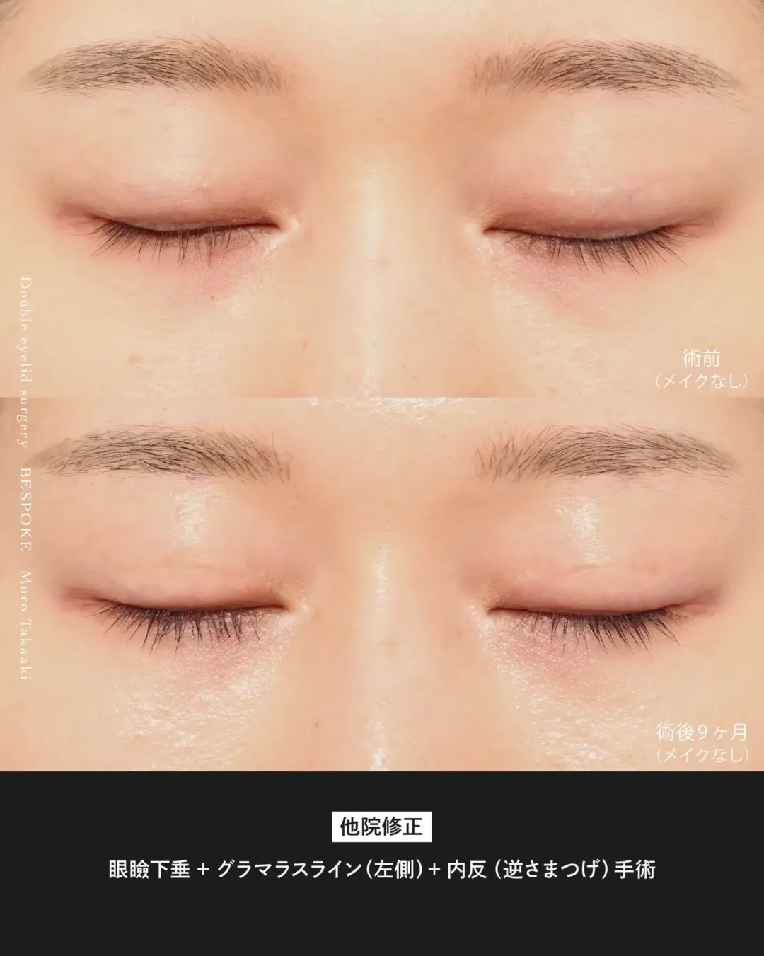 眼瞼下垂_260221 (2) 眼瞼下垂、グラマラスラインの症例