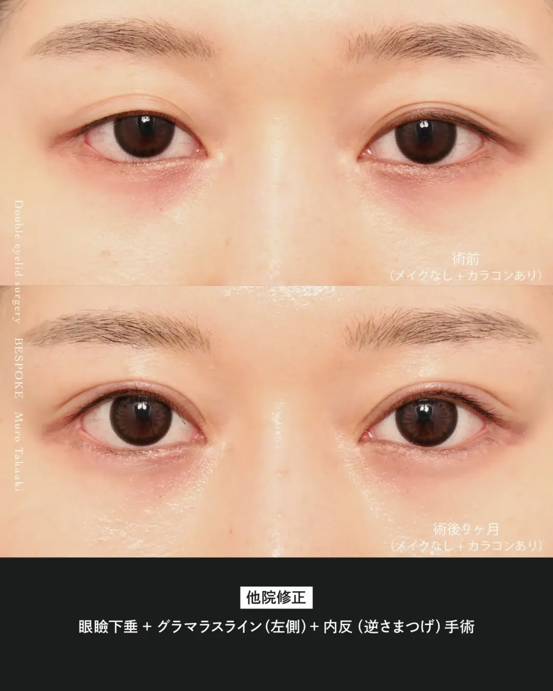 【眼瞼下垂】目元の左右差をなくし、ぱっちり二重に改善