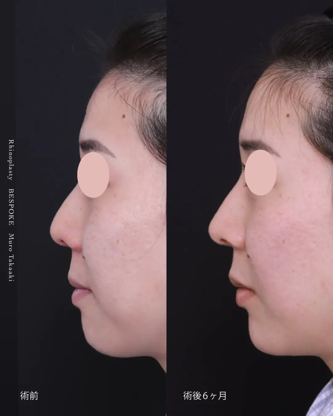 鼻11 (1) 鼻中隔延長術、鼻尖縮小術、鼻孔縁挙上術、ヒアルロン酸注入(ニューヴィア)の症例