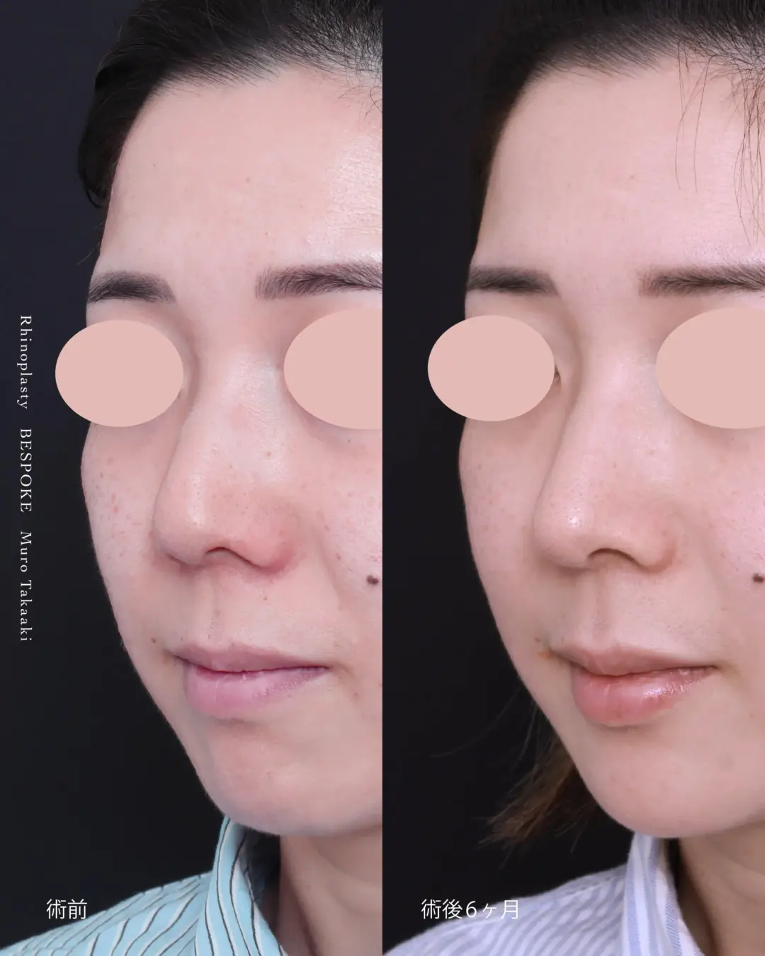 鼻11 (2) 鼻中隔延長術、鼻尖縮小術、鼻孔縁挙上術、ヒアルロン酸注入(ニューヴィア)の症例