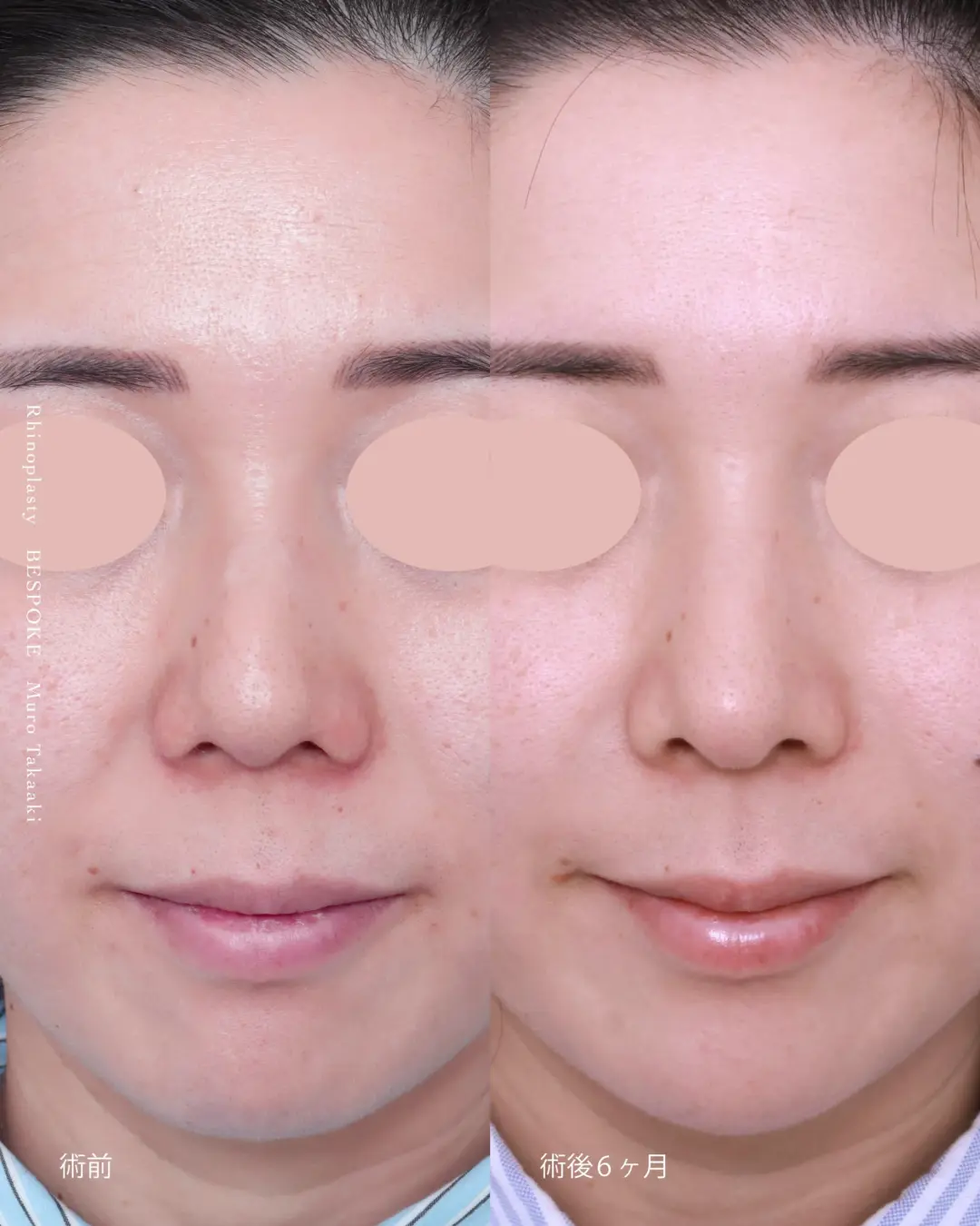 【鼻整形】鼻を小さく、人中を短く見せる。鼻孔縁挙上を併用した自然な鼻整形