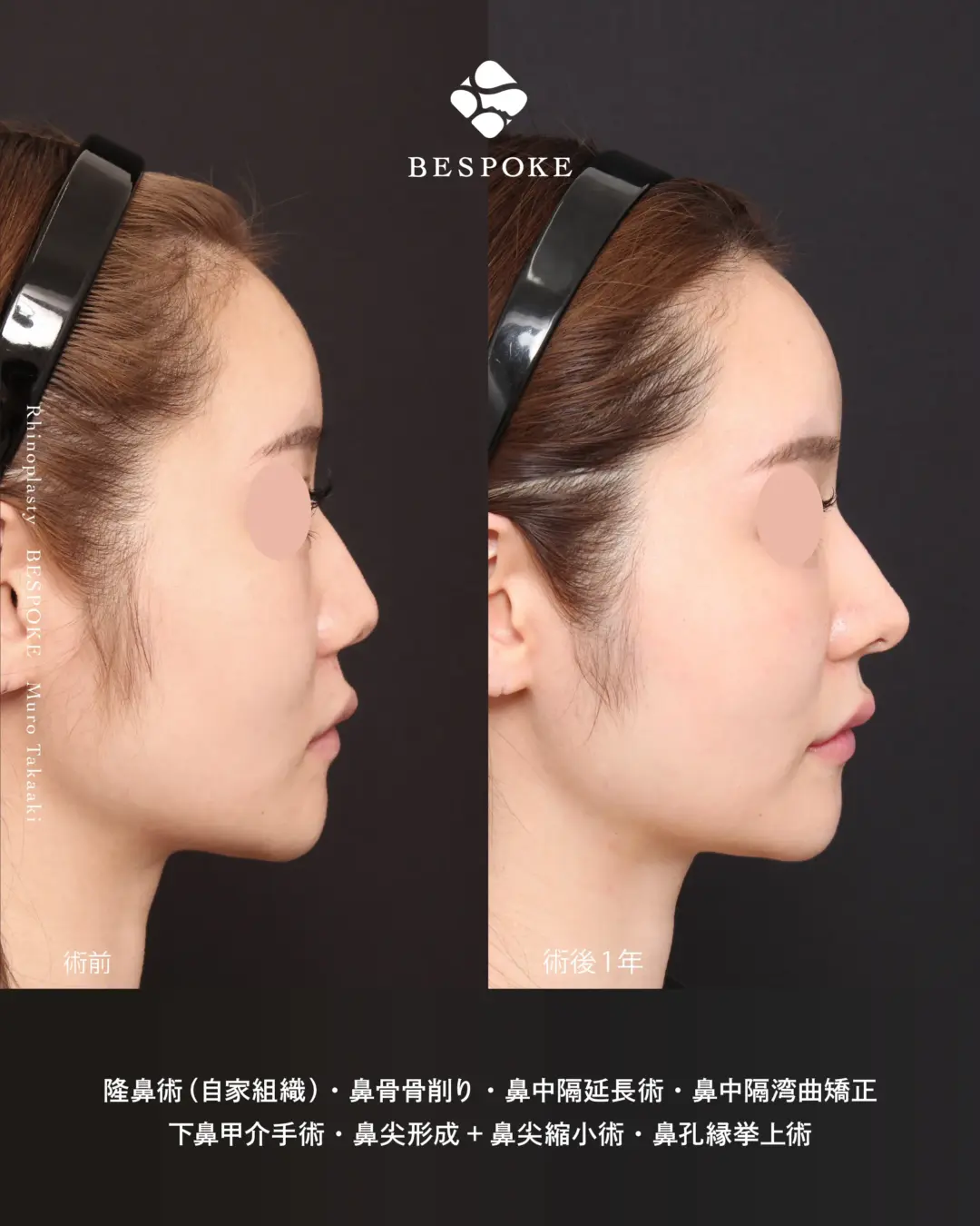 【鼻整形】鼻の丸みとぼってり感を「リニオン型」で整形感のない鼻へ改善