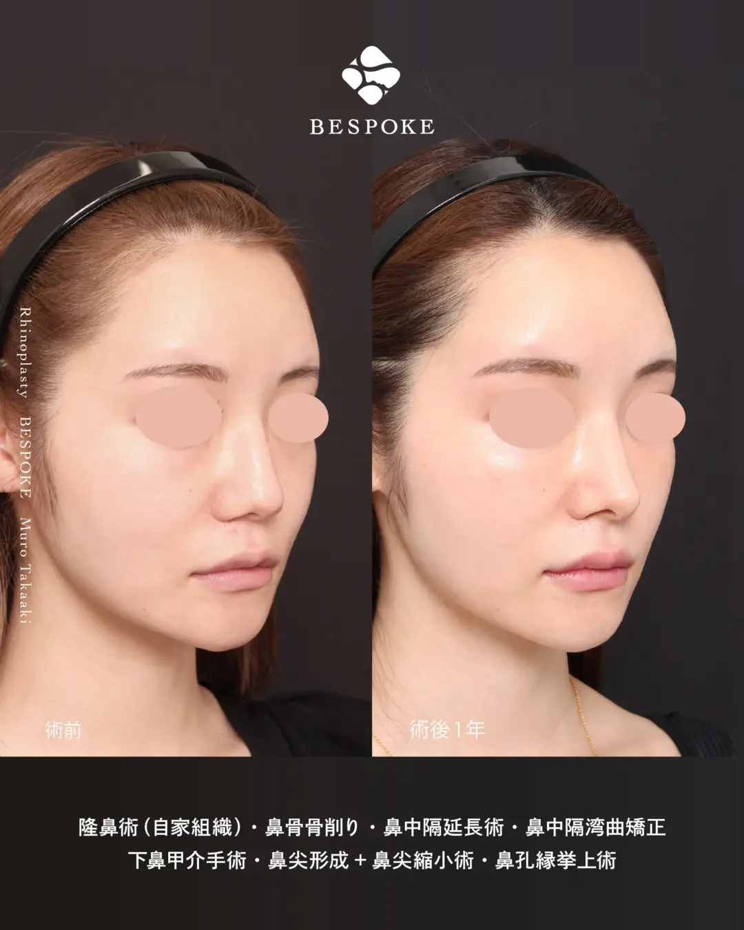 鼻整形_リニオン型1 (2) 隆鼻_鼻骨骨削り_鼻中隔延長_鼻中隔湾曲症修正_下鼻甲介粘膜下骨折手術_鼻尖形成_鼻尖縮小_鼻孔縁挙上術の症例