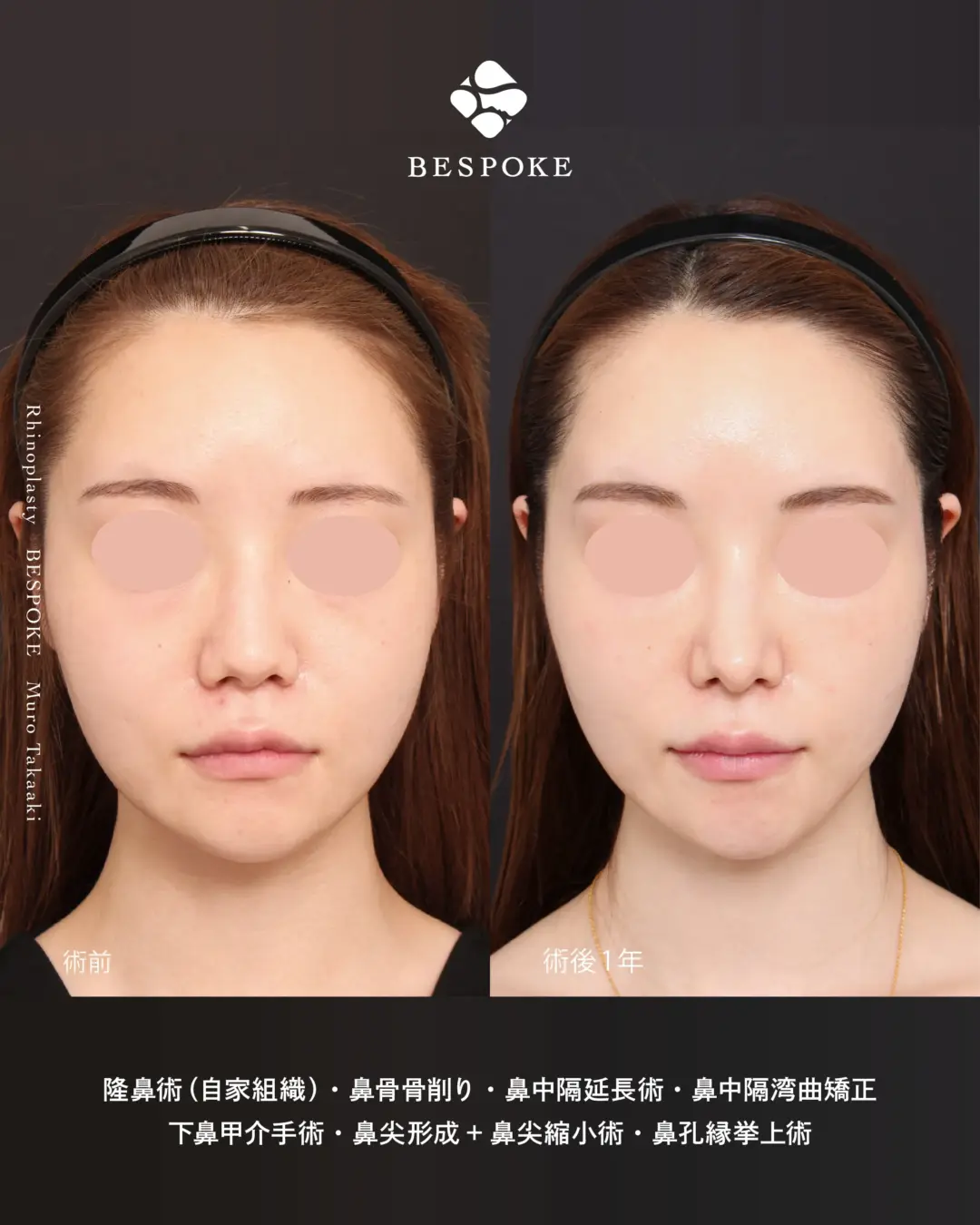 鼻整形_リニオン型1 (3) 隆鼻_鼻骨骨削り_鼻中隔延長_鼻中隔湾曲症修正_下鼻甲介粘膜下骨折手術_鼻尖形成_鼻尖縮小_鼻孔縁挙上術の症例