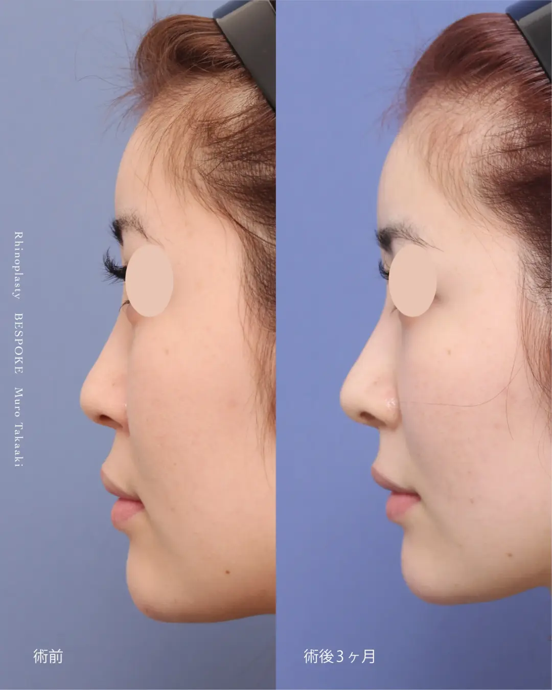 【鼻整形】平らでのっぺりとして見える横顔を骨格に合わせて改善する