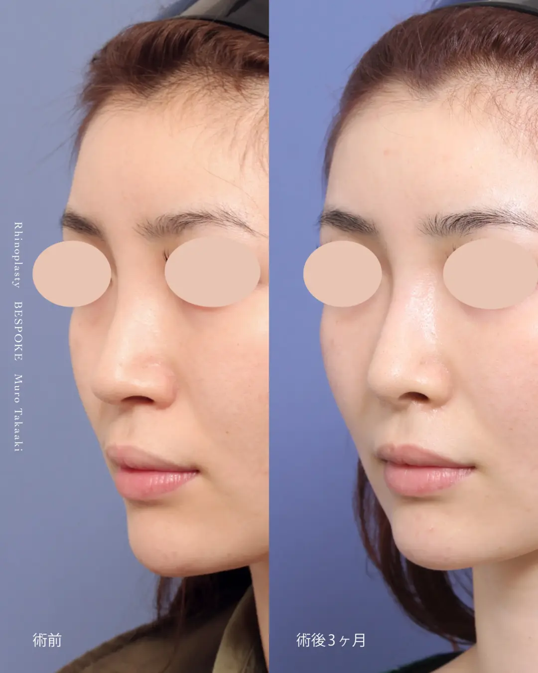 隆鼻術、鼻中隔延長、鼻尖縮小、鼻翼基部の症例