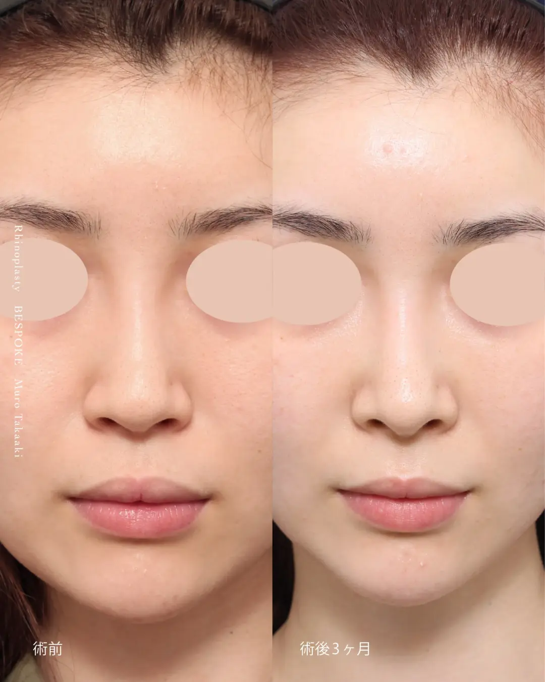 隆鼻術、鼻中隔延長、鼻尖縮小、鼻翼基部の症例