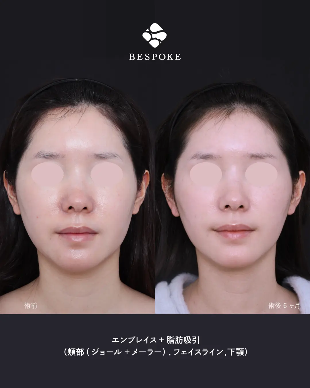 【小顔・たるみ治療】頬や顎まわりの脂肪やたるみをエンブレイスRFと脂肪吸引で改善