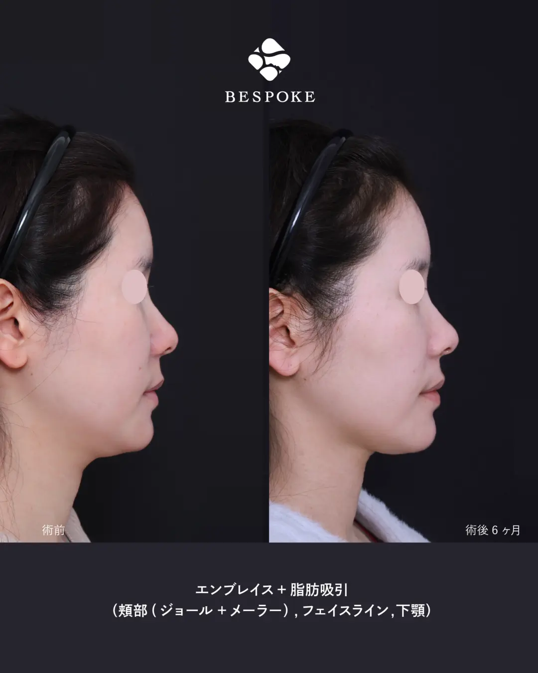 エンブレイス、脂肪吸引の症例