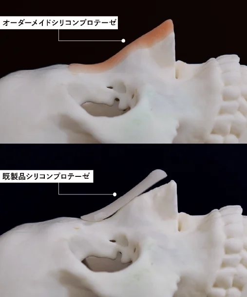 オーダーメイドプロテーゼ