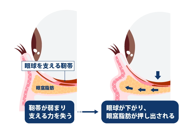  眼窩脂肪の突出