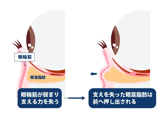  眼輪筋の衰え