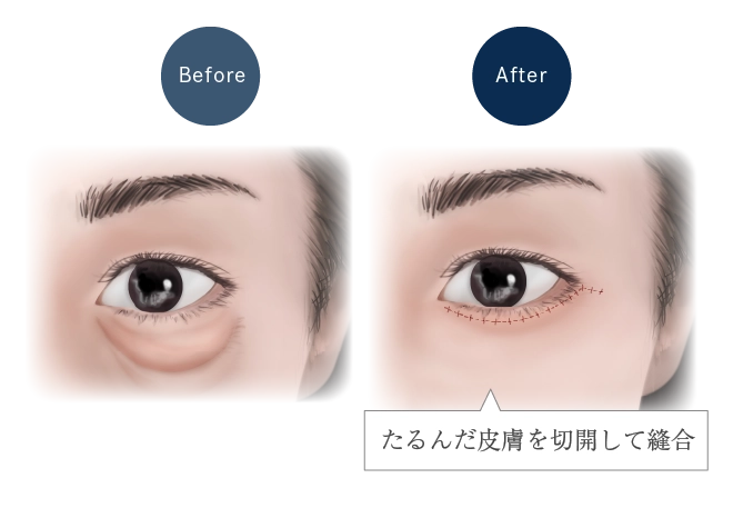 下眼瞼切開術イメージ