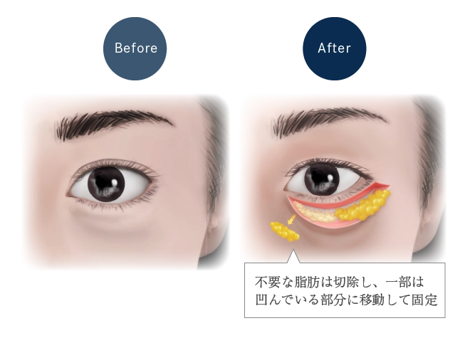 ハムラ法イメージ