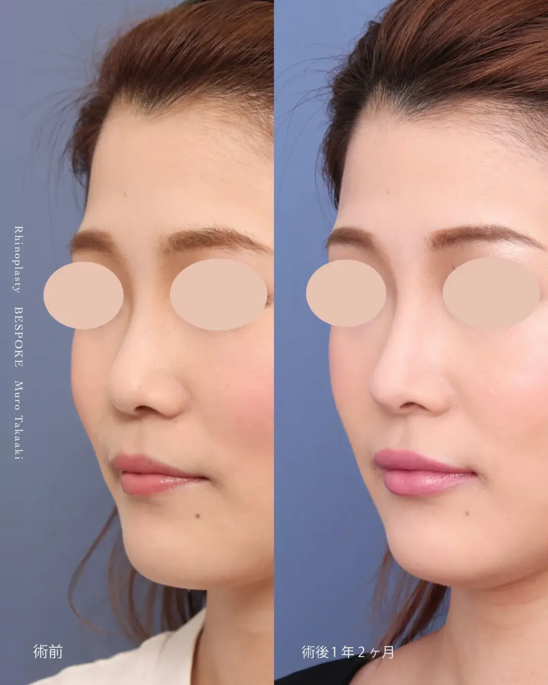 コンケイブタイプ01 (1) 眉間プロテーゼ挿入術、隆鼻術、鼻中隔延長術の症例