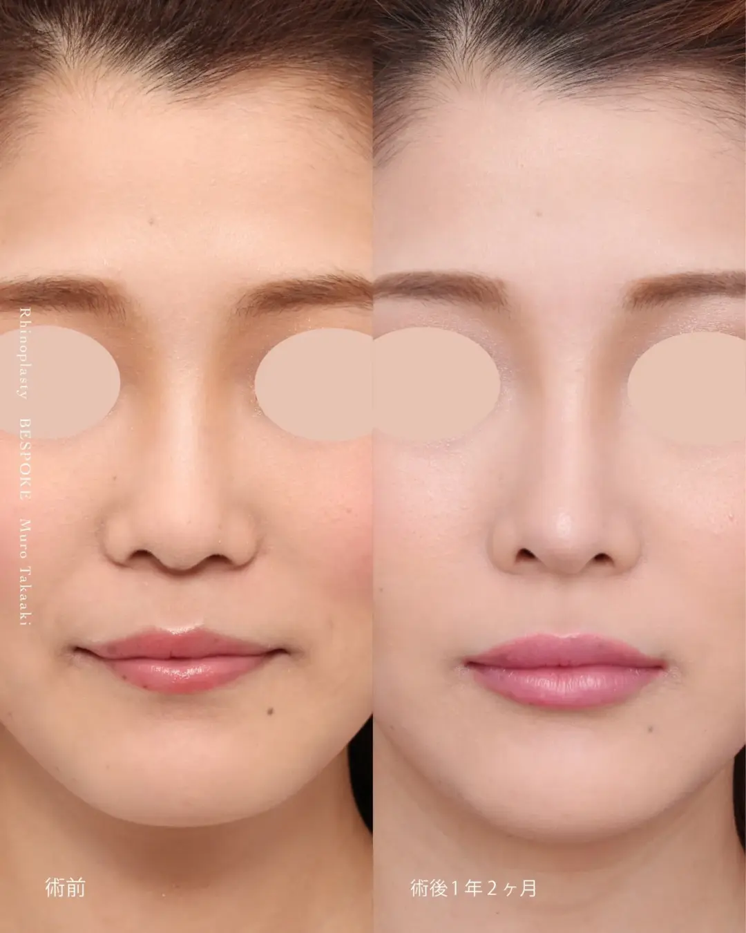 コンケイブタイプ01 (2) 眉間プロテーゼ挿入術、隆鼻術、鼻中隔延長術の症例