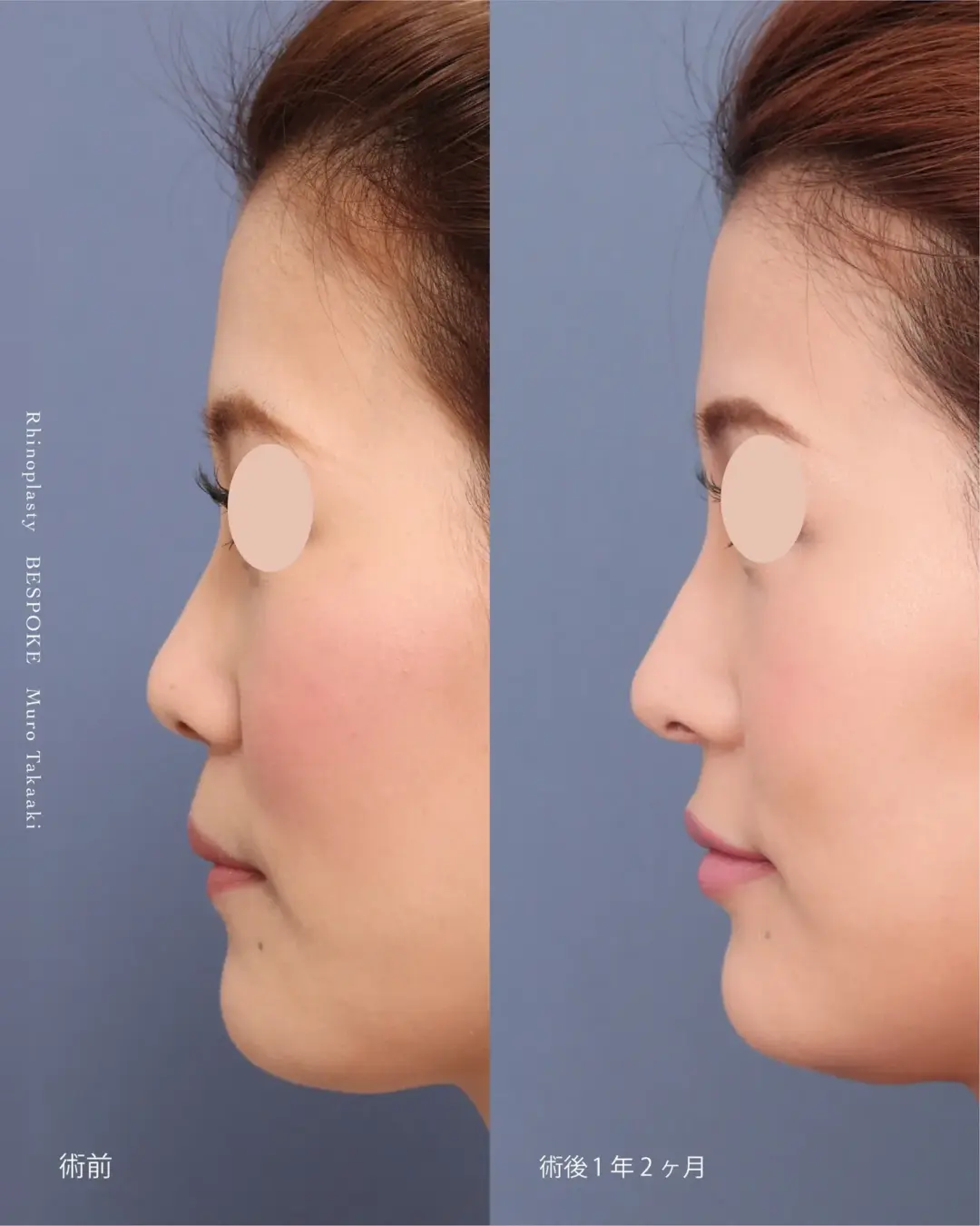 【鼻整形】大きく長く見える顔をリニオン型で立体感のある顔に改善