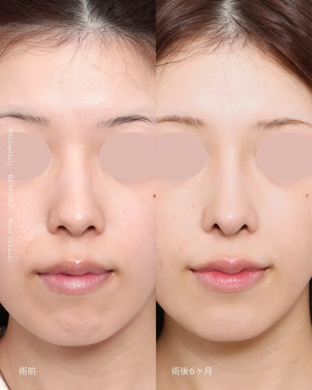 リニオン02 (1) 眉間プロテーゼ挿入術、隆鼻術の症例