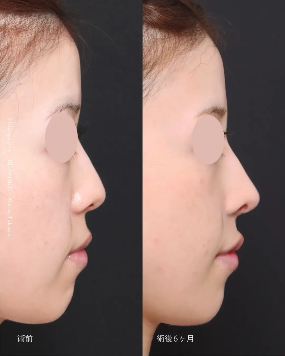 【鼻整形】もう少し鼻先の高さを出したい。「ストレート+リニオン型」で自然な立体感を。