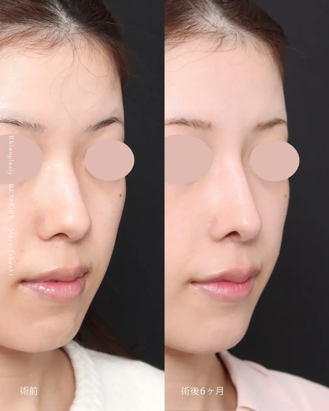 リニオン02 (3) 眉間プロテーゼ挿入術、隆鼻術の症例