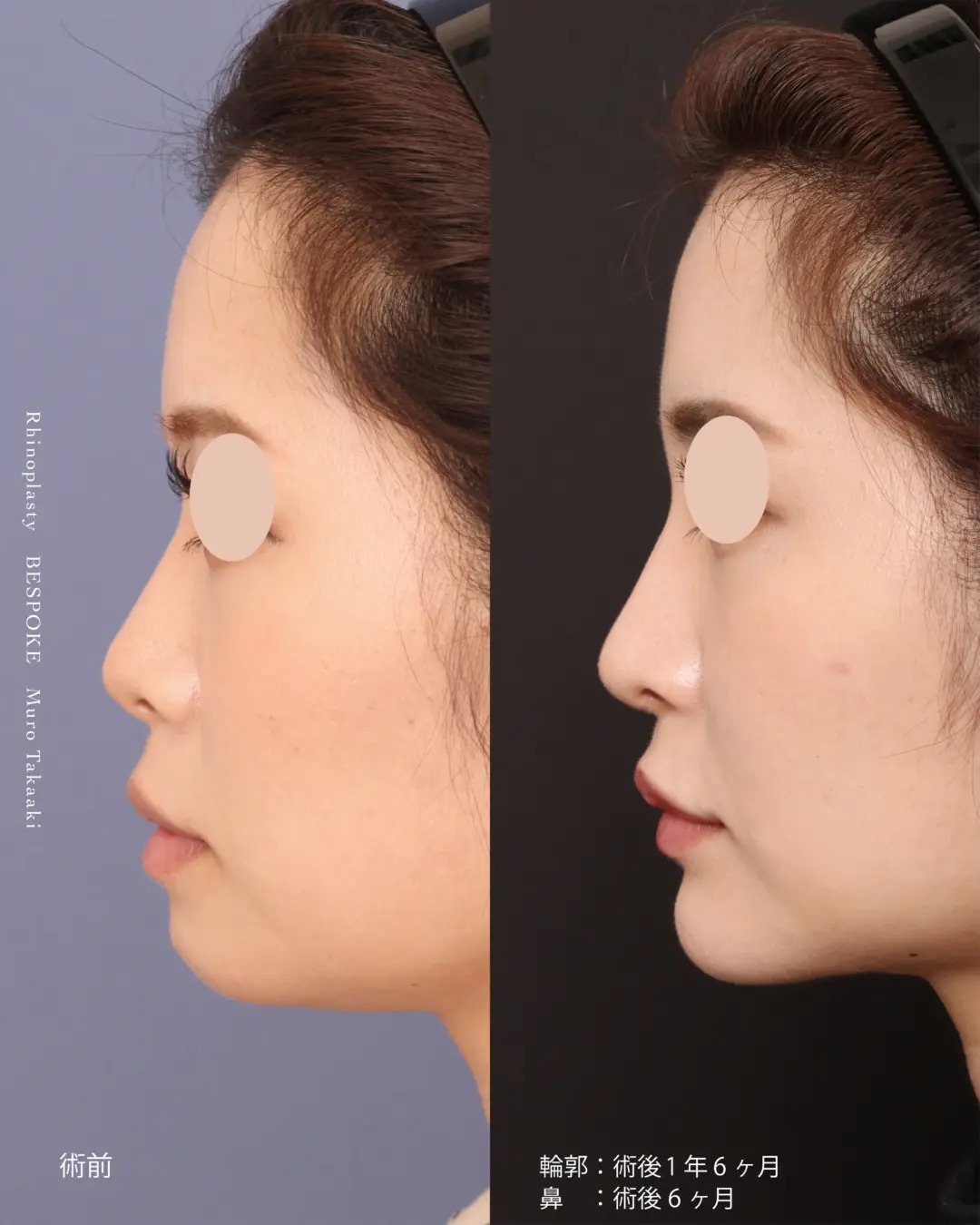 【鼻整形】真ん中がくぼんでいて口元が出てみえる顔を鼻と顎のバランスで綺麗なEラインをつくる