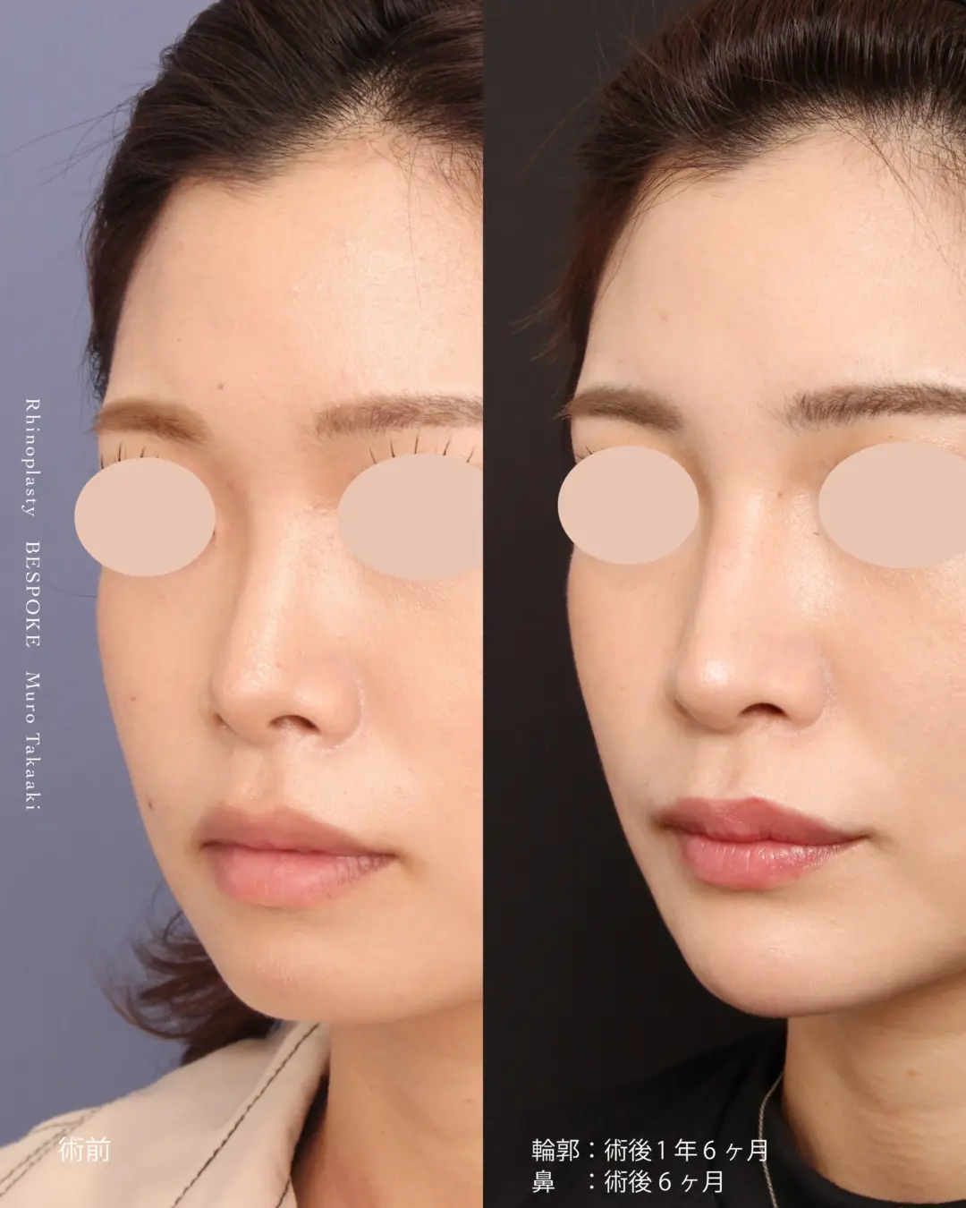 眉間プロテーゼ挿入術、隆鼻術、鼻中隔延長術、鼻尖縮小術の症例