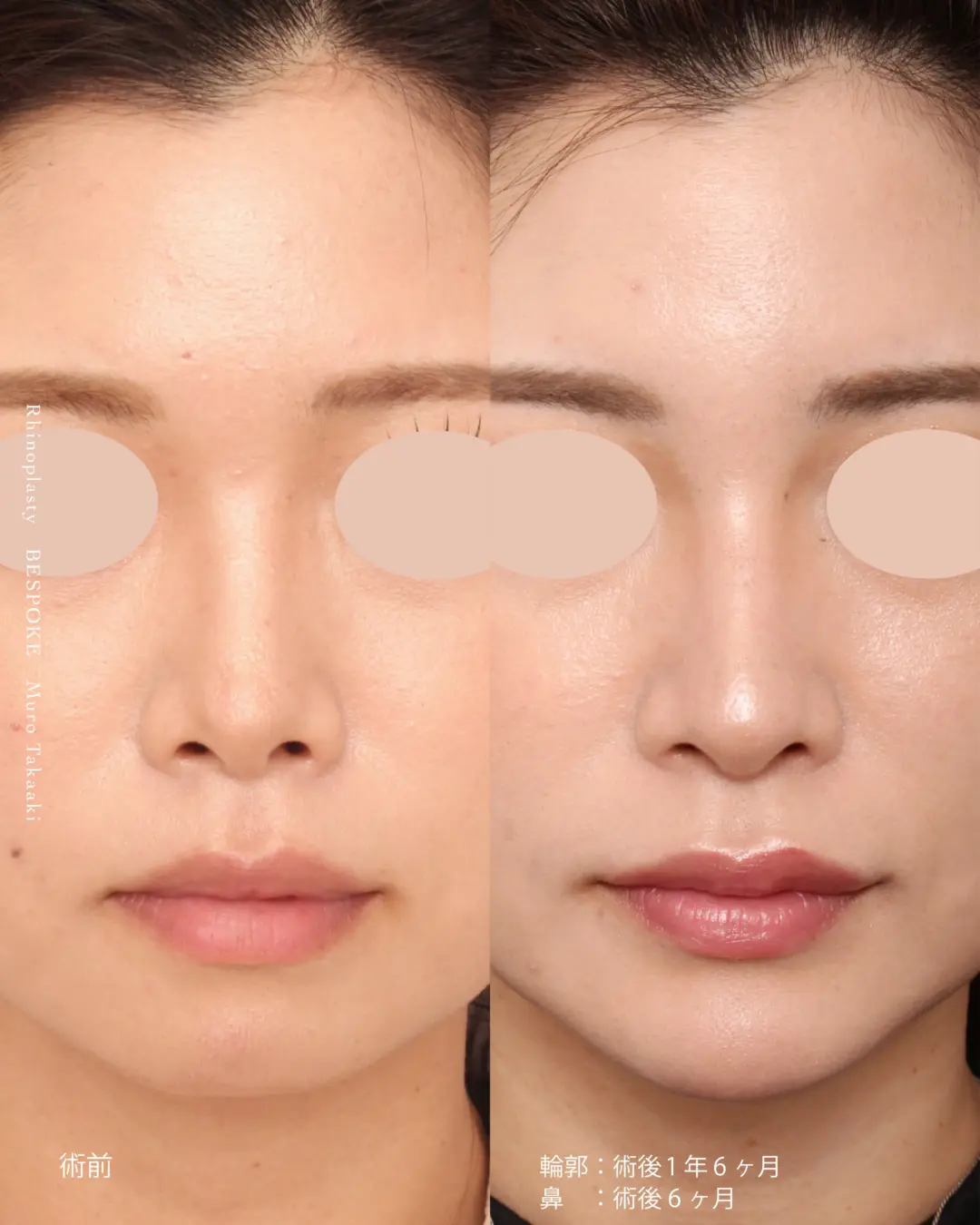 眉間プロテーゼ挿入術、隆鼻術、鼻中隔延長術、鼻尖縮小術の症例