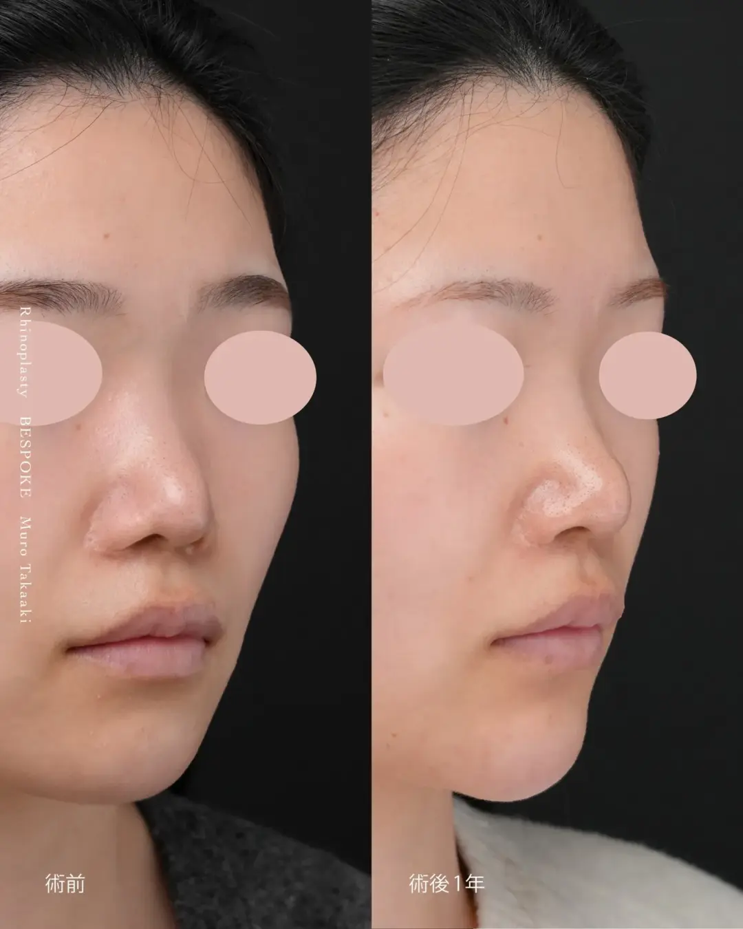 他院修正_鼻翼縮小 (1) 鼻翼縮小術の他院修正の症例