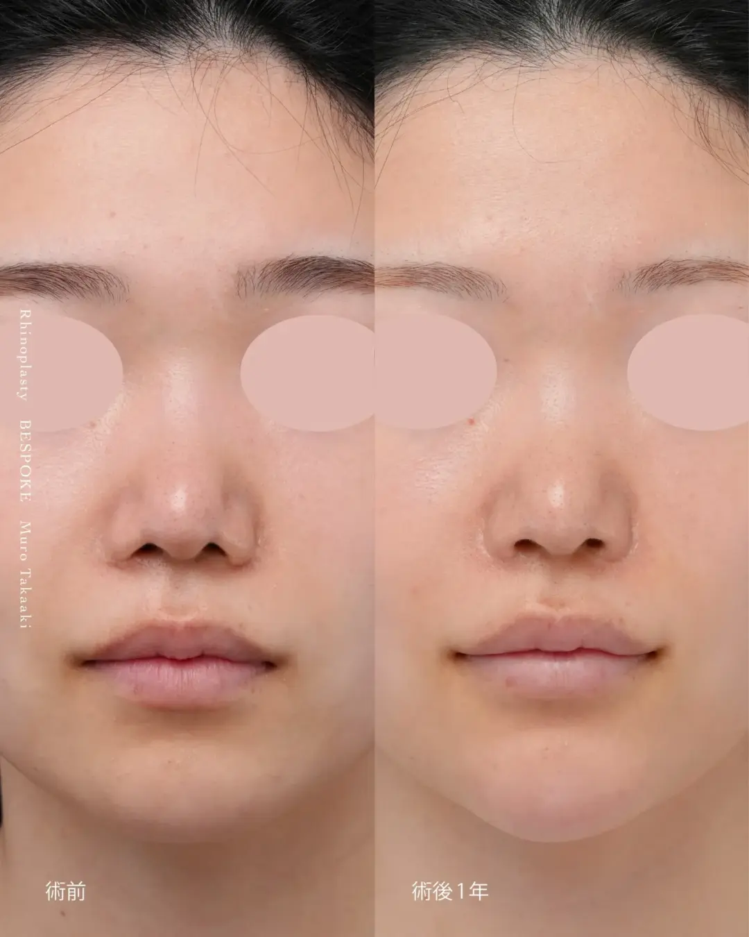 【鼻整形】一目でわかる整形感と左右差を修正し美しい鼻の穴に改善