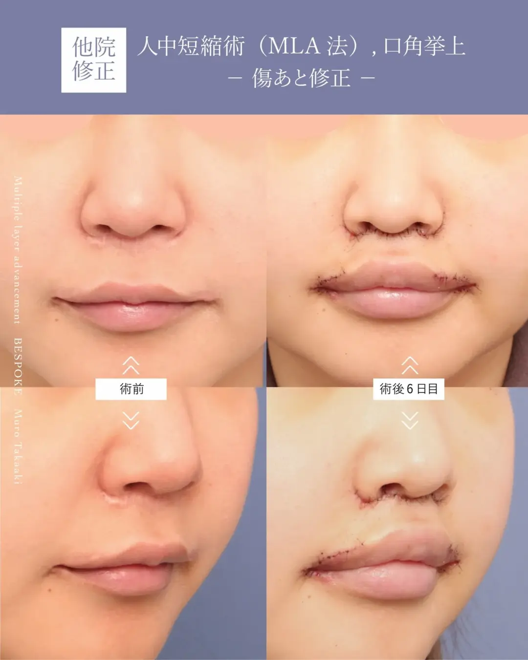 【上口唇短縮術（人中短縮術）】他院での人中短縮の傷跡を目立ちにくく自然に